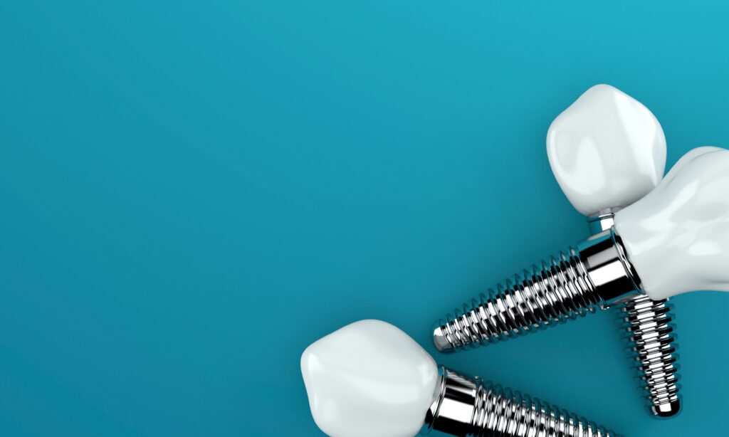 Replacing Lost Teeth With Dental Implants Kansas City, MO