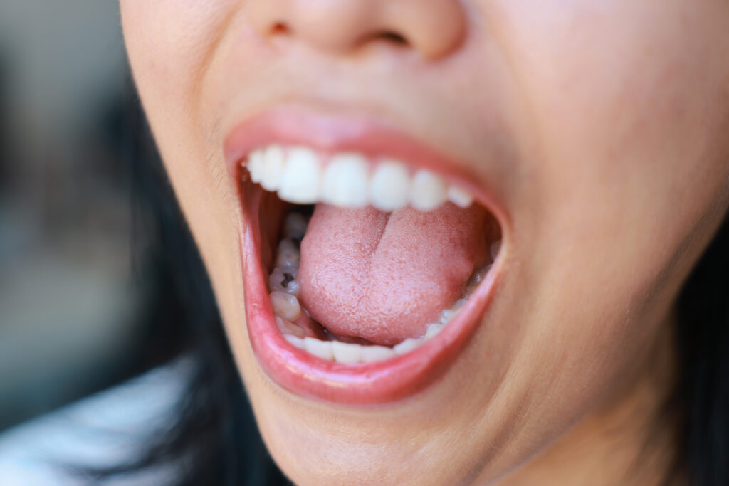 Close-up of tooth decay young Asia woman, So we should be care dental with the hygiene. Oral health problems and plaque and tartar. concept of Healthy, Dentistry, beauty, health care, treatment.