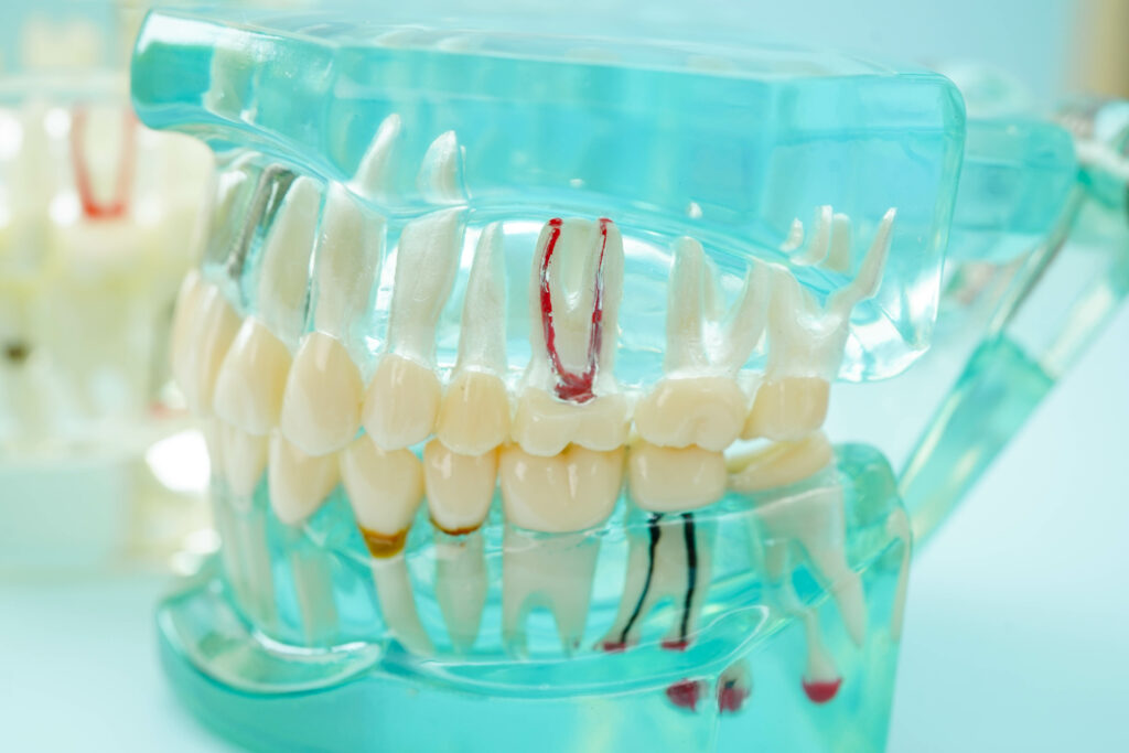 kansas city root canal