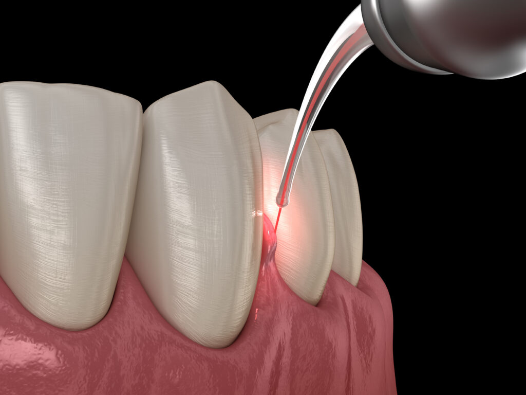 kansas city gum contouring