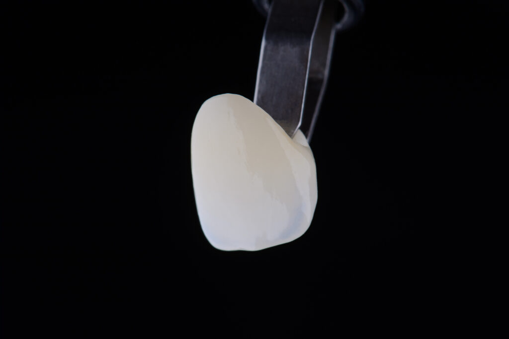 kansas city veneers
