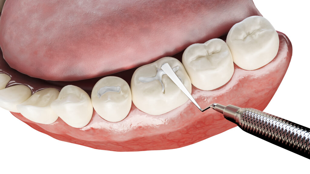 kansas city dental fillings