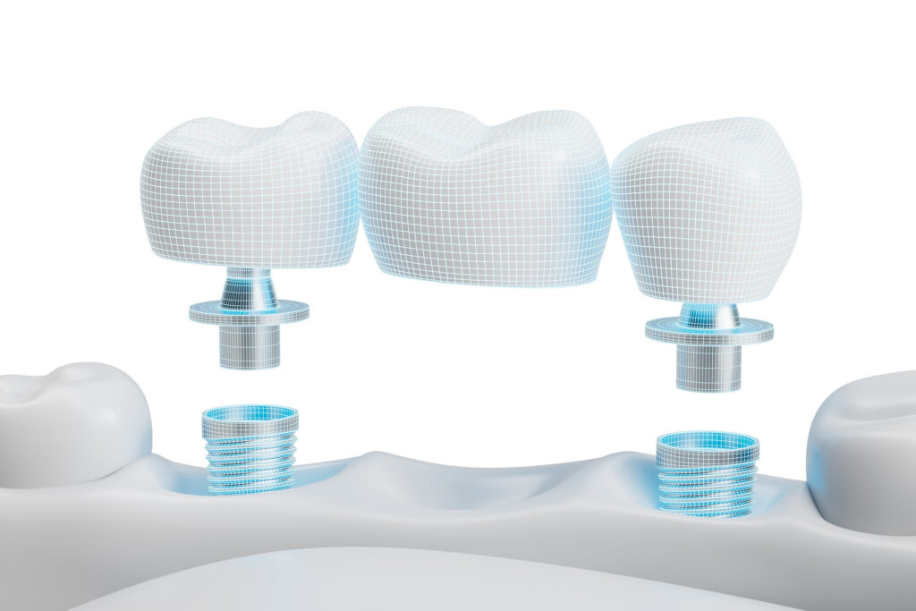 kansas city implant bridge