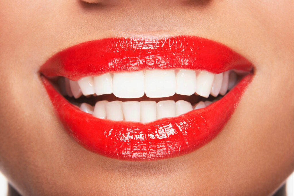 kansas city veneers