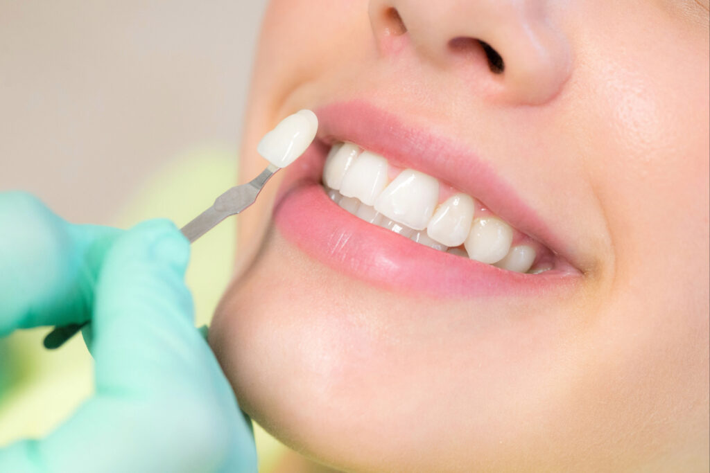 kansas city veneers