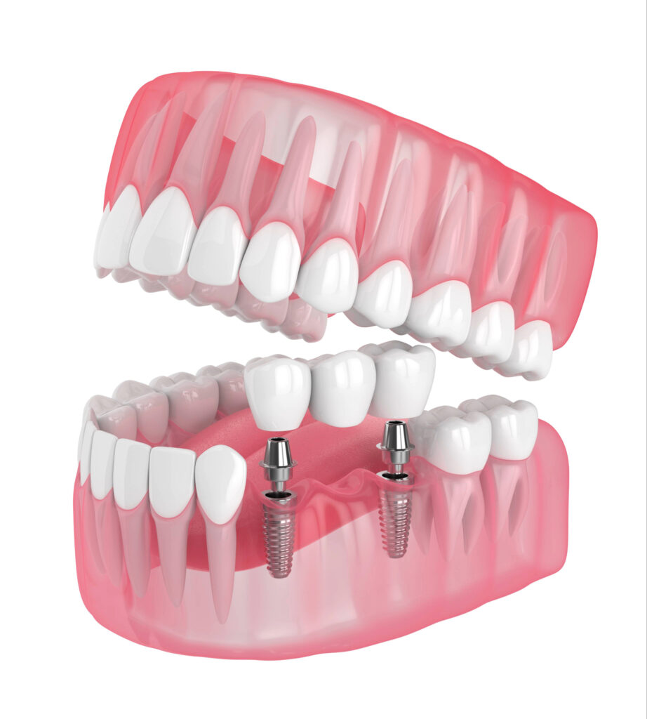 kansas city dental bridges