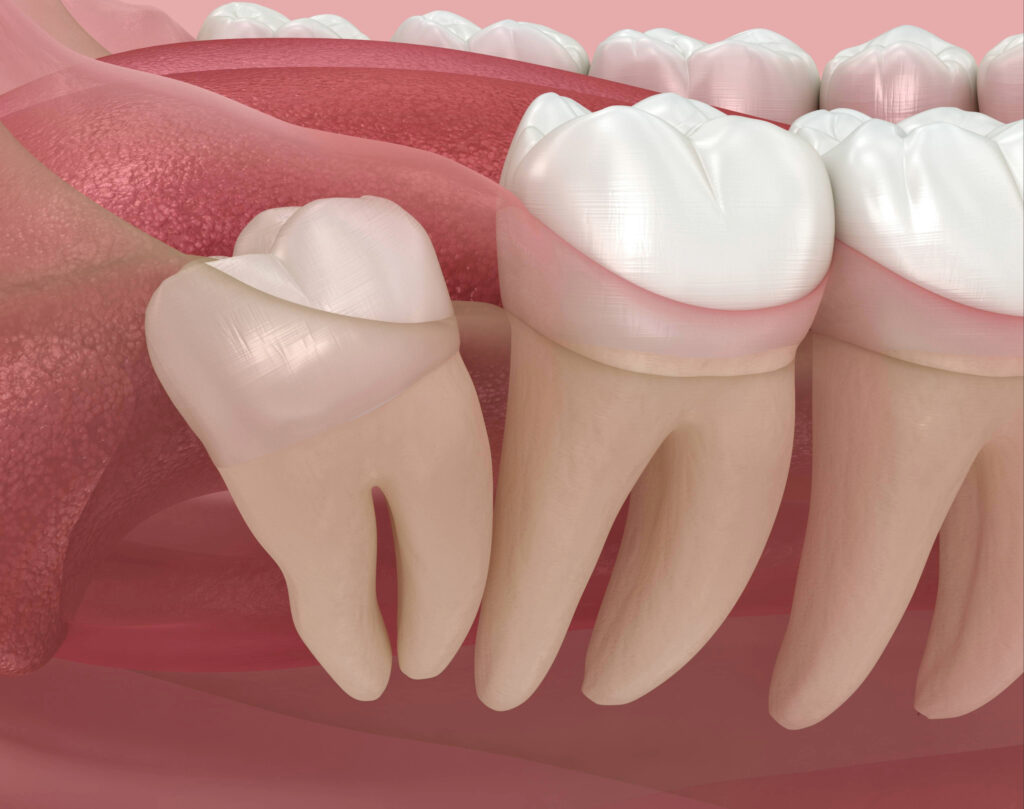 kansas city wisdom tooth extraction